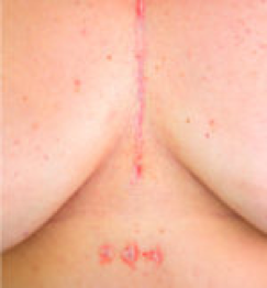 chest scar
