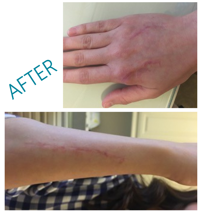Before and after views of silicone gel treatment in scar management.